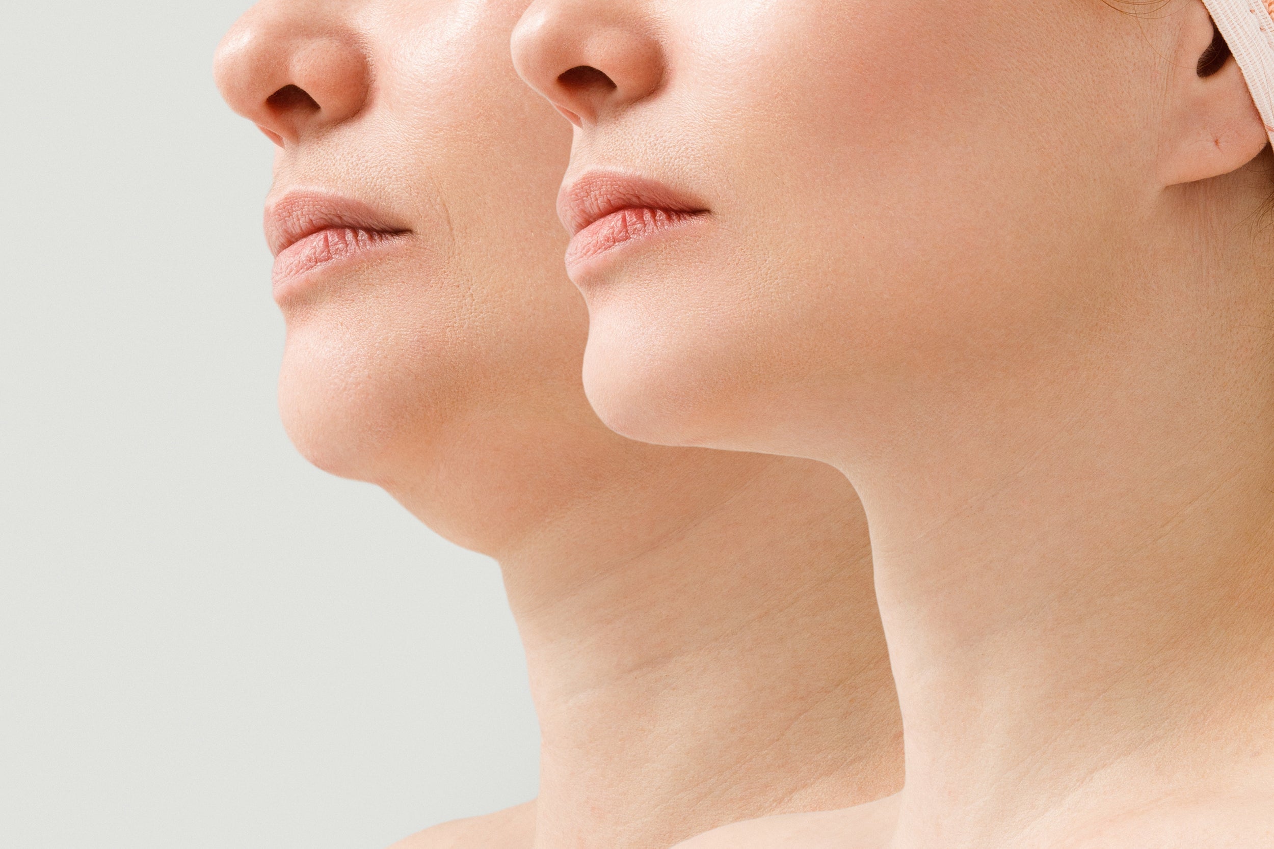 A photo illustration shows potential before and after effects after cosmetic surgery to the chin, including potentially liposuction. Sulinu's Before + After Vitals is a cosmetic surgery supplement designed to help chin liposuction bruising.