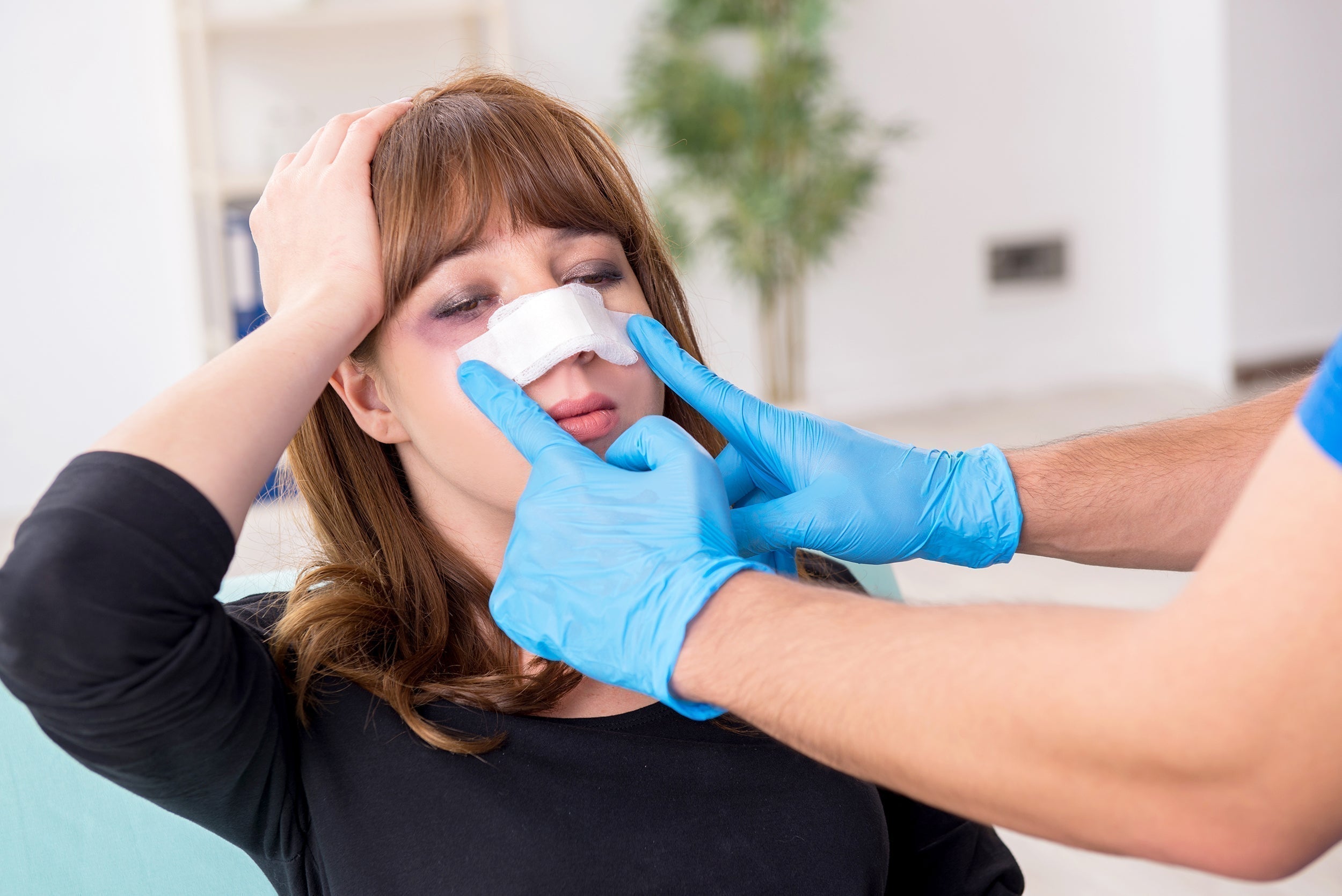 A woman shows bruising following a cosmetic procedure of the face. If you're preparing for surgery, learn which supplements can reduce bruising in our complete guide.