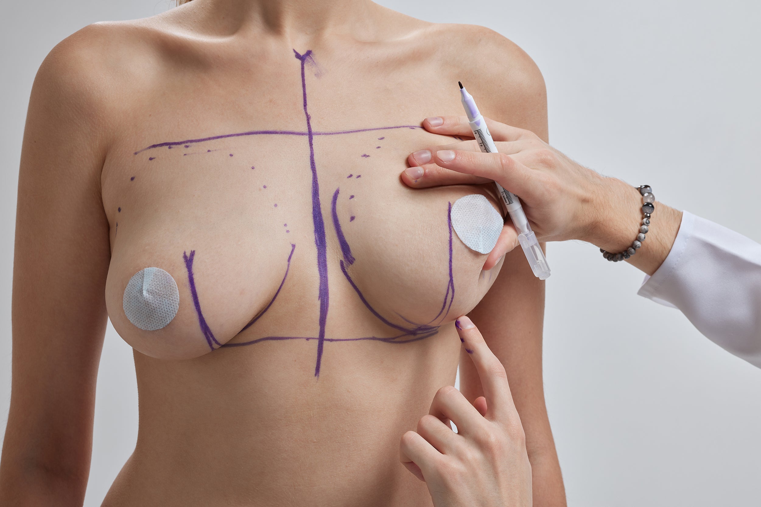A person with surgical markings on their chest prepares for breast surgery. A medical professional uses a marker to draw lines and gestures while another hand points at an area on the chest.