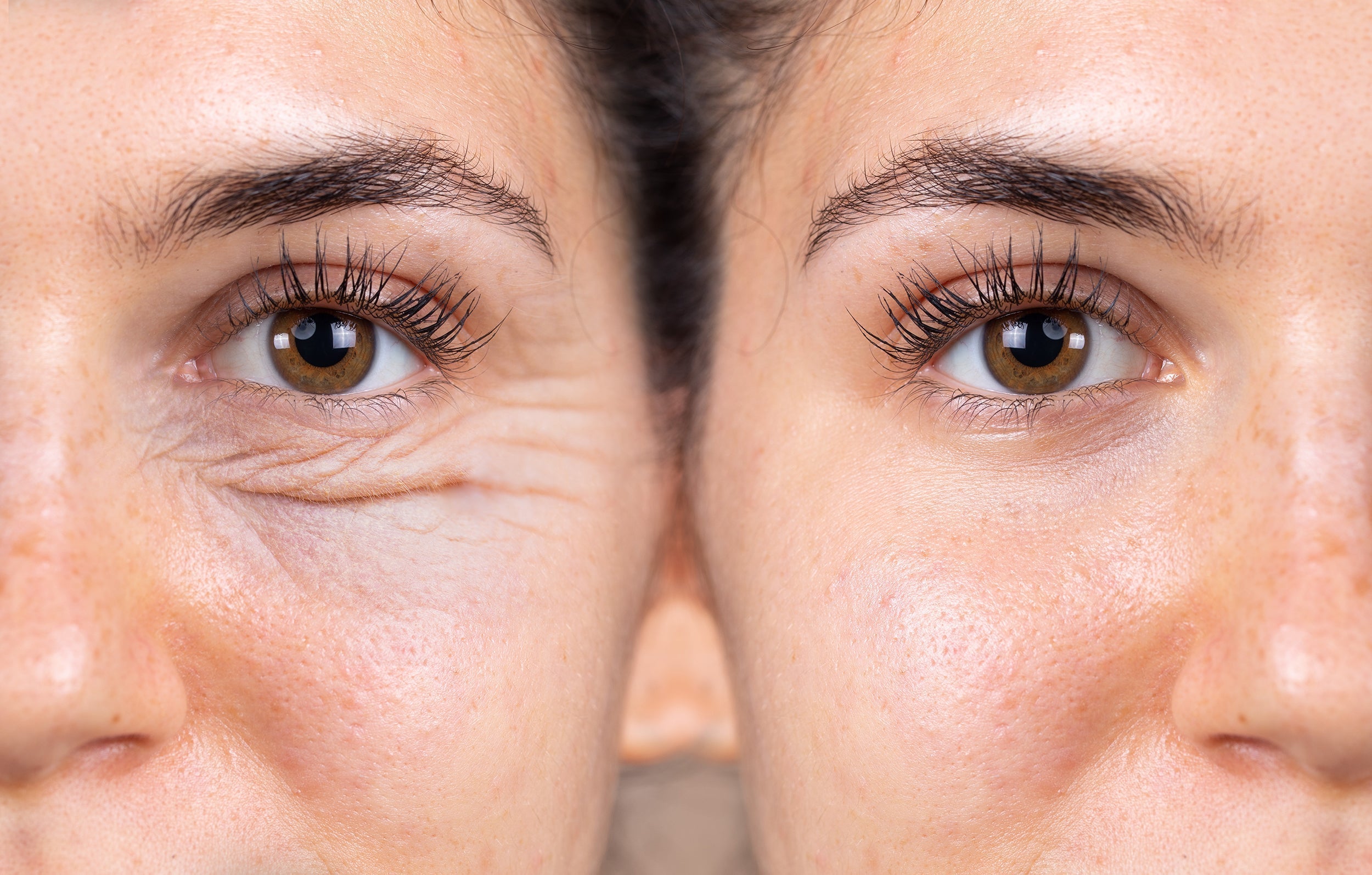 A detail photo shows a before and after results from a blepharoplasty. Explore our complete guide on the stages of bruising following a blepharoplasty and be prepared for your procedure.